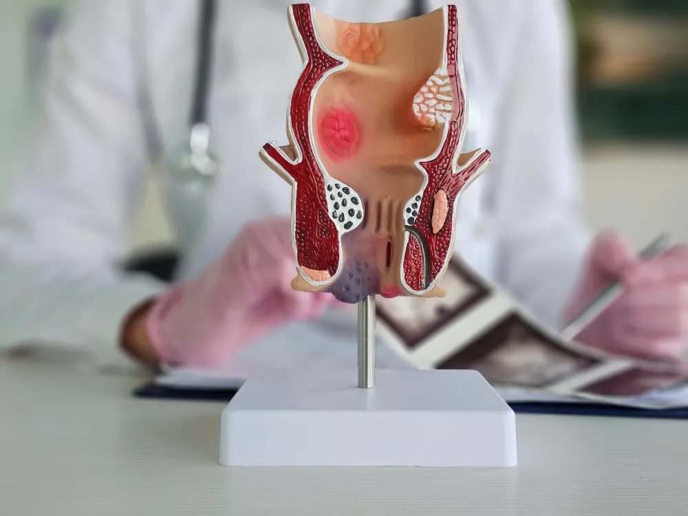 Anatomical model of a diseased rectum