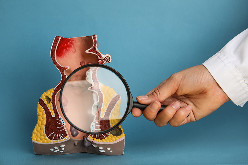 A magnifying glass held against an anatomical model of a rectum