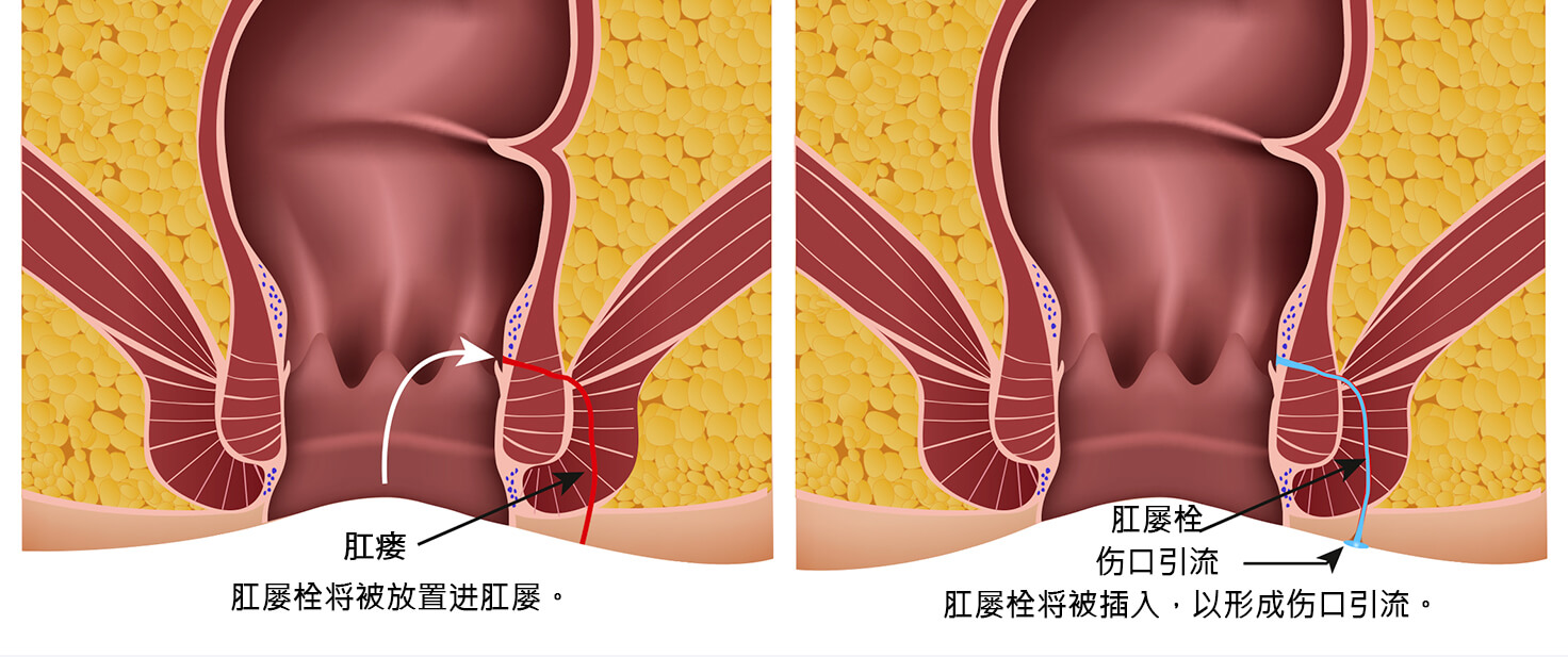 Common Anal Fistula Repair and Surgery Treatments